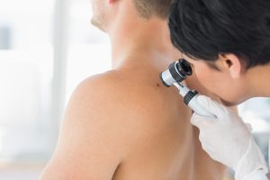 Skin Cancer: Doctor examining mole on back of man